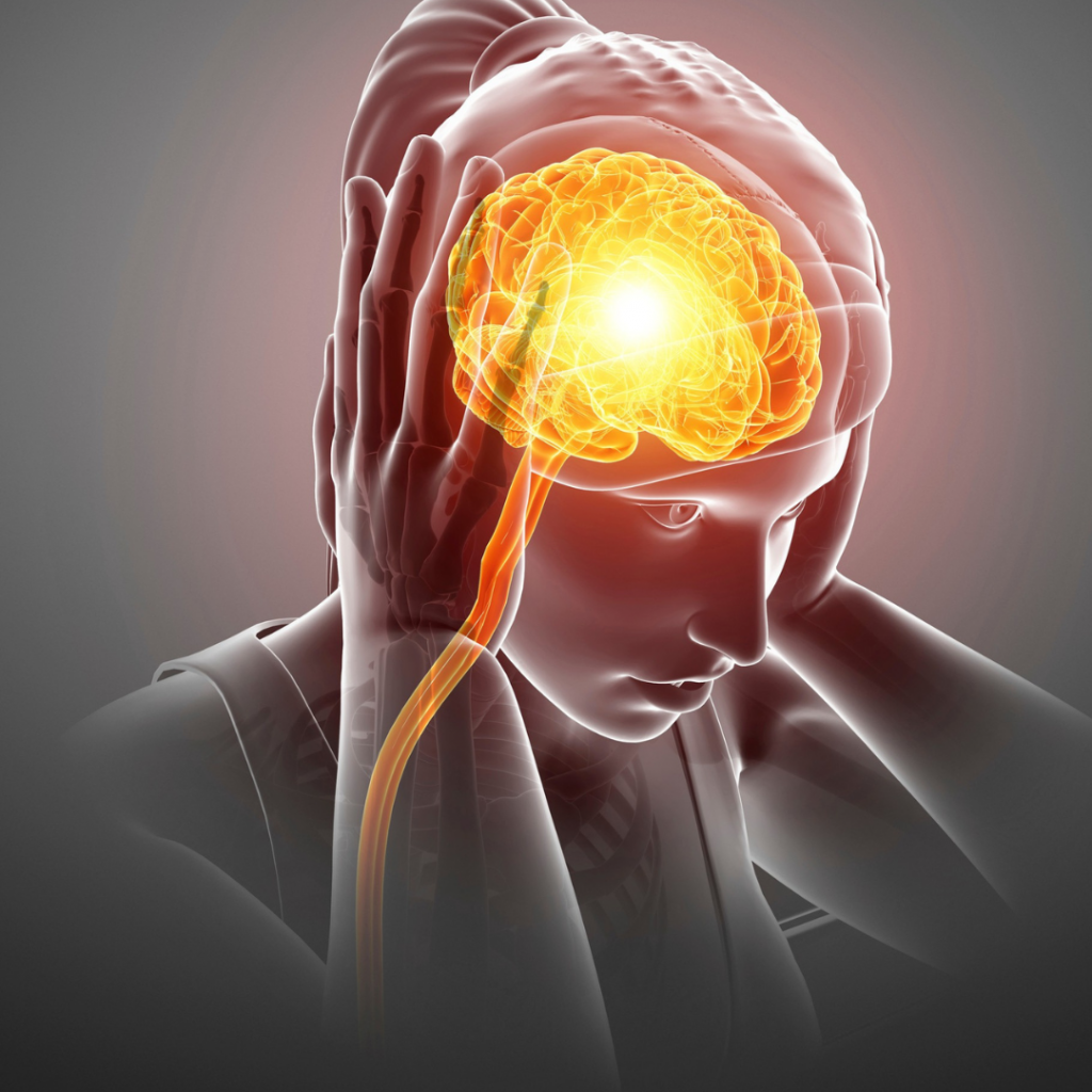 Ilustración del cerebro durante un episodio de migraña crónica.